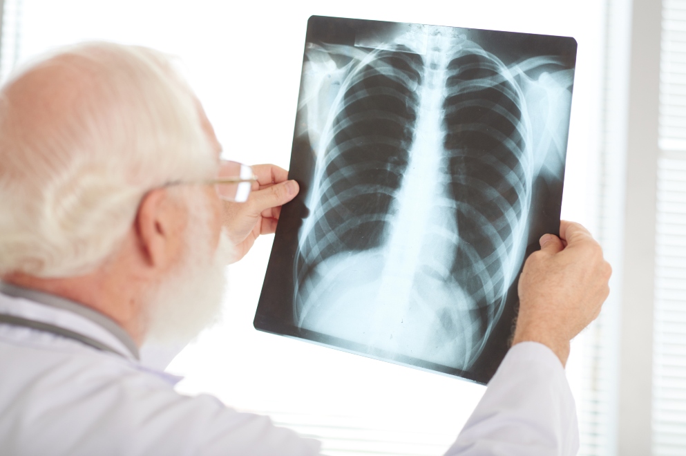 Cuáles son los síntomas de la Tuberculosis y cuándo hacer una consulta